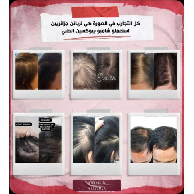 Bioxcin Shampoing Pour La Perte De Cheveux Forte - Pour Femme Et Homme